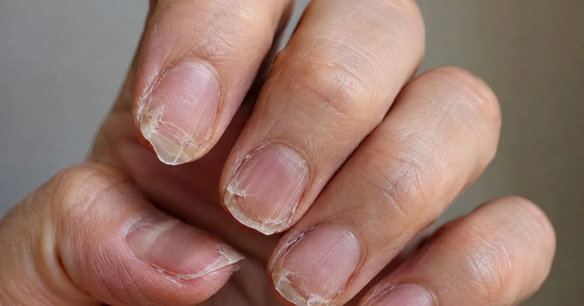O que fazer quando as unhas começam a descamar e quebrar